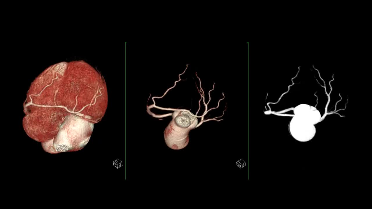 CTA冠状动脉三维渲染显示心脏血管冠状动脉在屏幕上旋转。视频素材