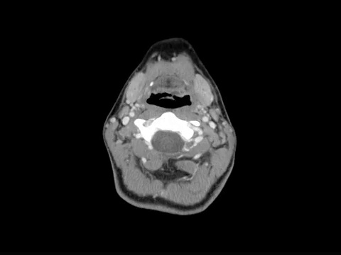 脑部和头部CAT扫描视频下载