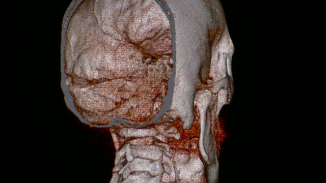 人颅骨CU CT扫描/佛蒙特，美国视频素材