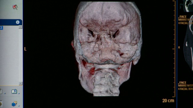 美国佛蒙特州的MS CT人类头骨扫描视频素材