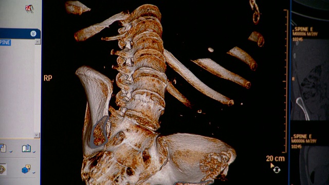 人下胸腔、脊髓和骨盆的CU CT扫描/ Vermont, USA视频素材
