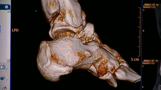 踝关节CU CT扫描/佛蒙特，美国视频素材