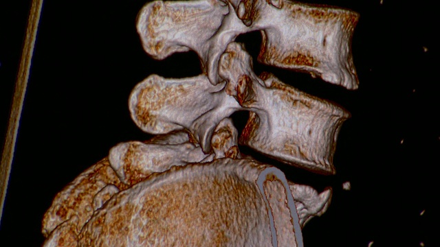 人脊髓和回肠ECU CT扫描/佛蒙特，美国视频素材