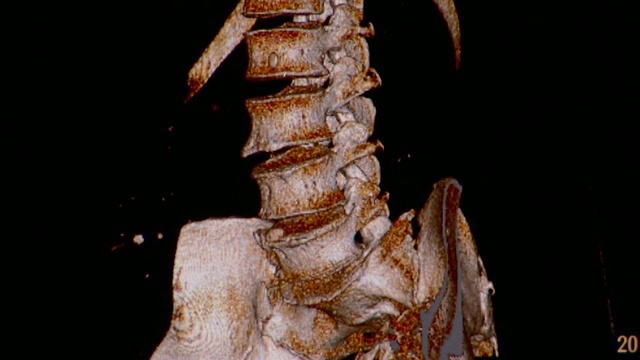 脊髓和回肠的CU CT扫描/ Vermont, USA视频素材