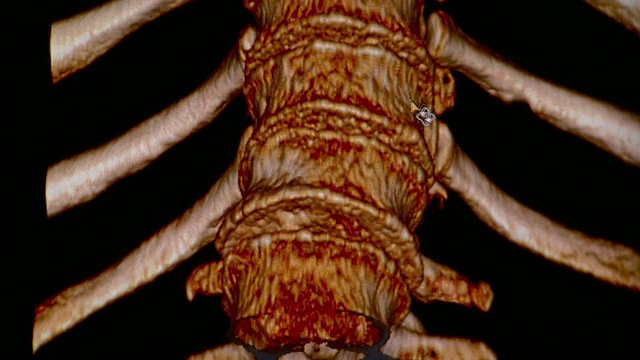 脊髓ECU CT扫描/佛蒙特，美国视频素材