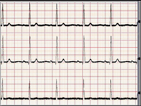 正常心电图3通道- NTSC视频素材
