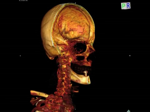 动画显示一个老人头部的3D CT扫描视频下载