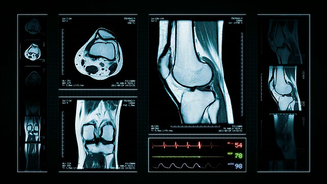 膝关节MRI扫描。顶部，正面和侧面视图。蓝色的。视频素材