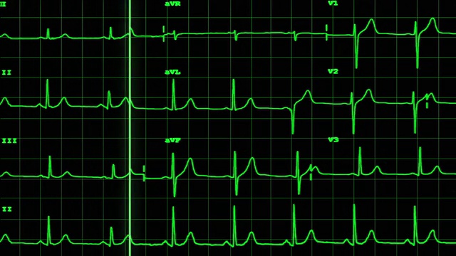 心电图显示有声音的心脏停止跳动视频素材