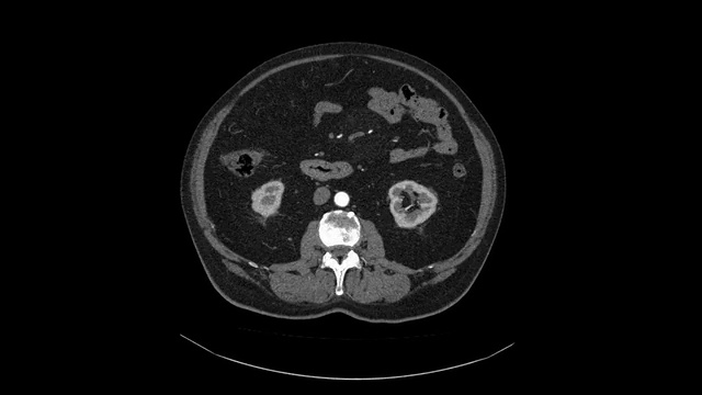 胸腔CAT扫描视频素材