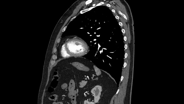 胸腔CAT扫描视频素材