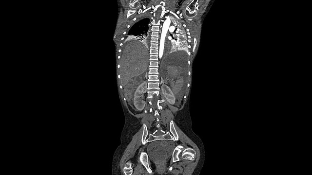 胸腹的CT血管造影术视频素材
