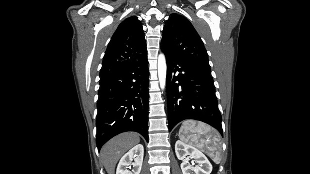 胸主动脉CT血管造影视频素材
