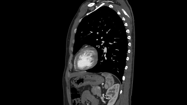 胸主动脉CT血管造影视频素材