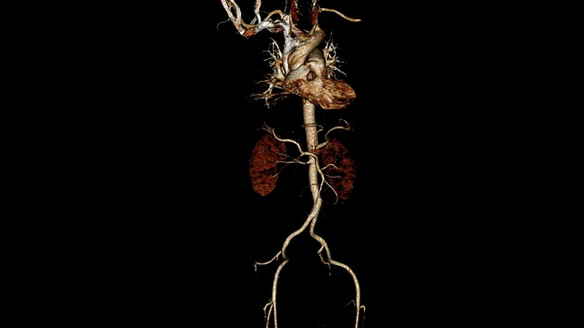 计算机断层扫描血管造影视频素材
