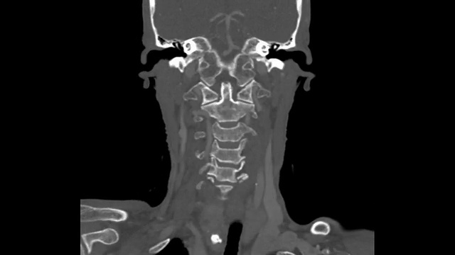 头部CAT扫描图像视频素材