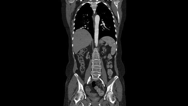胸主动脉CT血管造影视频素材
