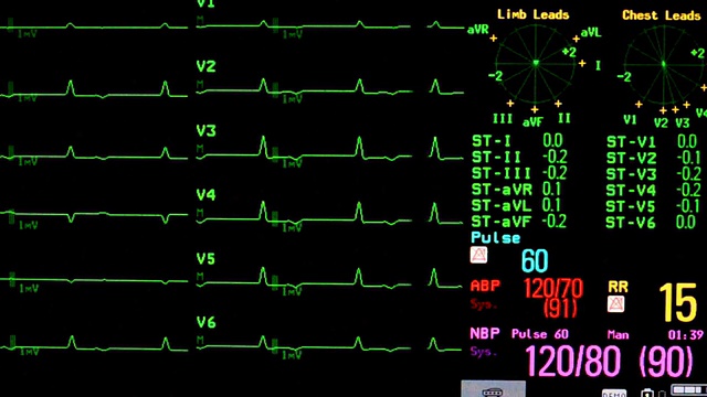心电图监测视频素材