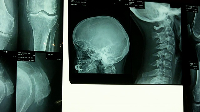 x射线图像(高清)视频下载