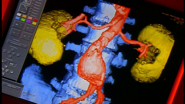 近距离在电脑显示器上显示脊柱+器官的CGI模型视频素材
