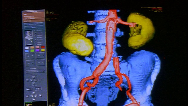 电脑显示器显示脊柱、髋骨和肾脏的CGI模型视频素材