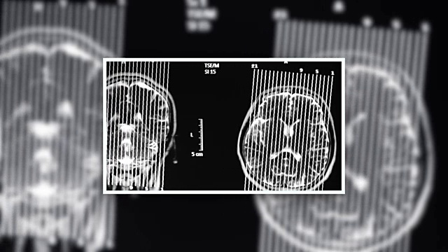 核磁共振视频素材
