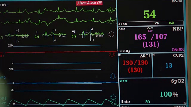 在外科手术或病人病房的电脑屏幕上的心电图的特写。视频素材