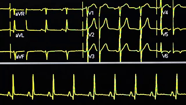 心电图视频素材