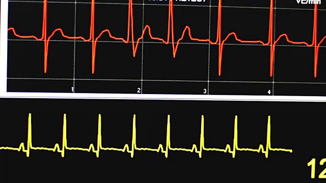 心电图视频素材