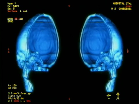 电脑生成的图像近距离显示人类头骨的一半，前后旋转180度，并加上文字和侧面的测量值视频素材