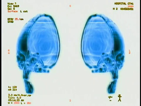 电脑生成的图像近距离显示人类头骨的一半，前后旋转180度，并加上文字和侧面的测量值视频素材