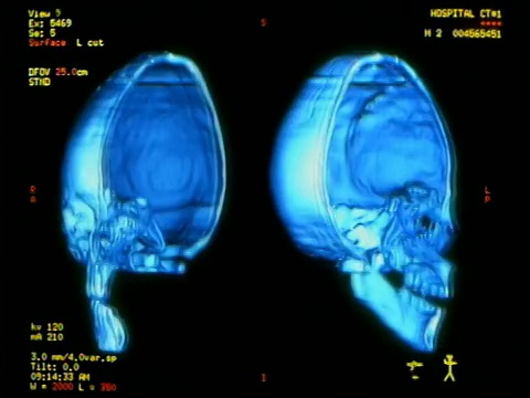 电脑生成的图像近距离显示人类头骨的一半，前后旋转180度，并加上文字和侧面的测量值视频素材