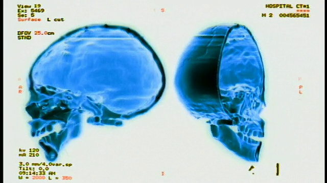电脑生成的图像近距离显示人类头骨的一半，前后旋转180度，并加上文字和侧面的测量值视频素材