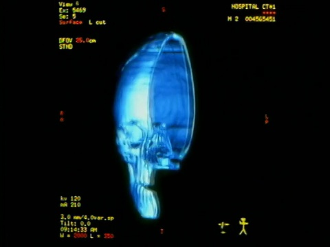电脑生成的图像近距离显示了人类头骨的一半，前后旋转180度，并附上文字和测量数据视频素材