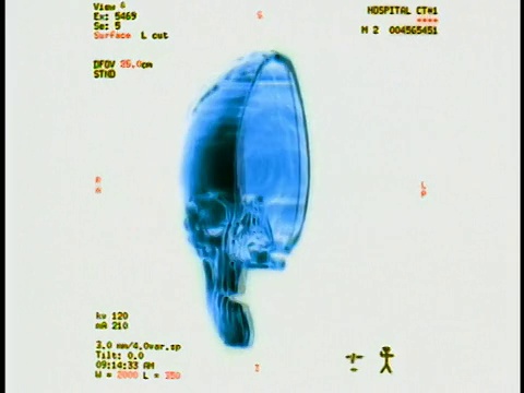 电脑生成的图像近距离显示了人类头骨的一半，前后旋转180度，并附上文字和测量数据视频素材