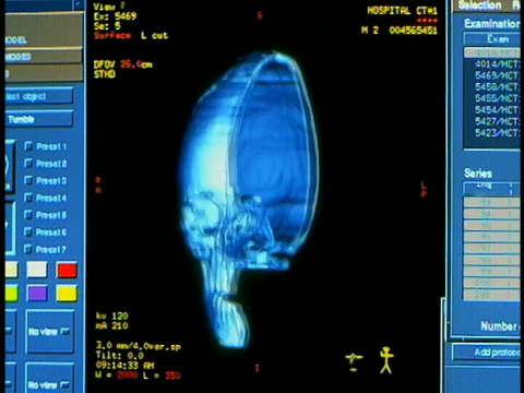 电脑生成的图像接近一半的人类头骨旋转180度来回与图表在显示器的一边视频素材