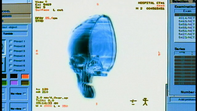 电脑生成的图像接近一半的人类头骨旋转180度来回与图表在显示器的一边视频素材