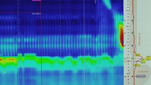 电脑屏幕上有一个彩色和高科技胃肠医学诊断显示，说明一个人从喉咙吞咽，通过食道到胃。视频素材