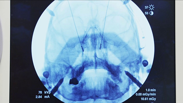 电脑x射线显示，在外科手术过程中神经电极插入大脑。视频素材