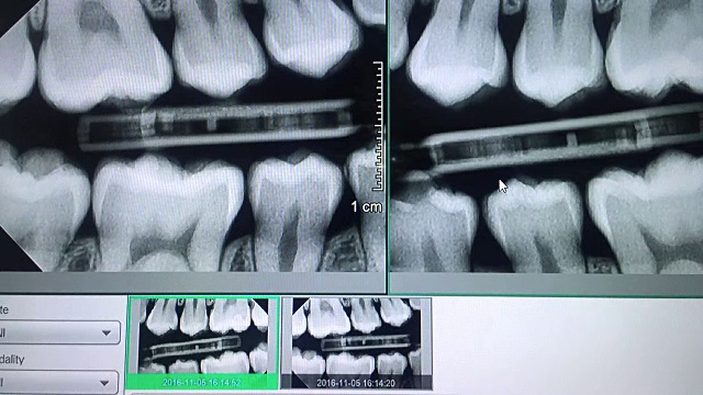 监视器上的牙齿全景x光视频下载