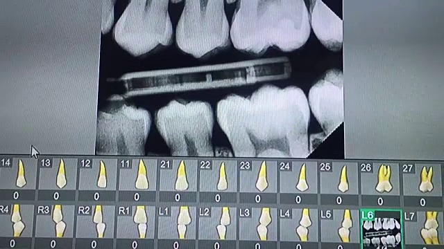 监视器上的牙齿全景x光视频素材