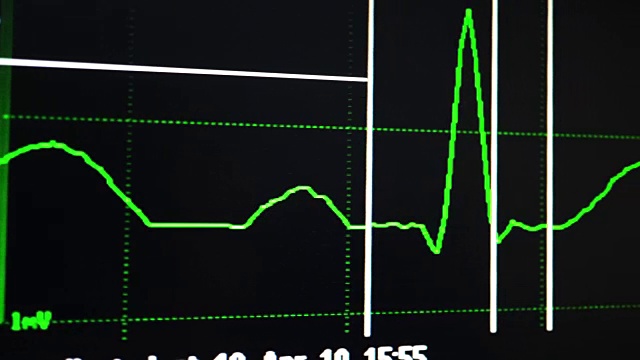心电图视频素材