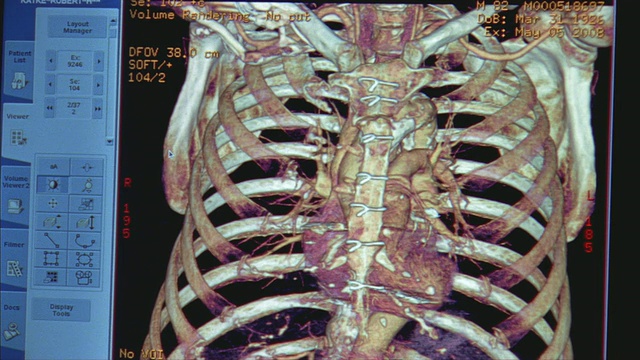 CU，电脑屏幕上的人体胸部CAT扫描，瑞典-美国心脏医院，罗克福德，伊利诺伊州，美国视频素材