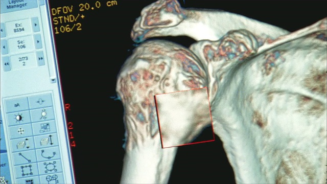 CU, TU，人体肩部计算机断层扫描，瑞典-美国心脏医院，罗克福德，伊利诺伊州，美国视频素材