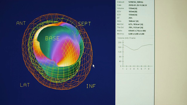 计算机显示器上的MS 3D心脏扫描/佩森，犹他州，美国视频下载