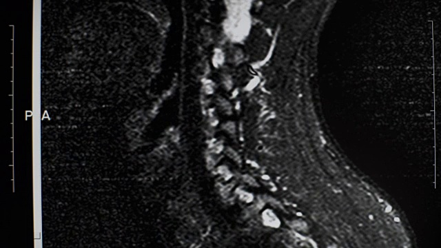 一个男人脊柱的磁共振成像视频素材