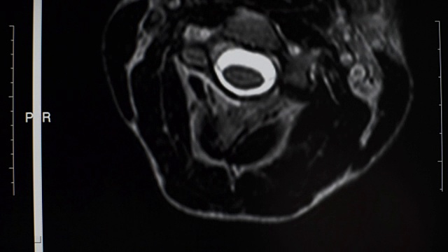 一个男人脊柱的磁共振成像视频素材