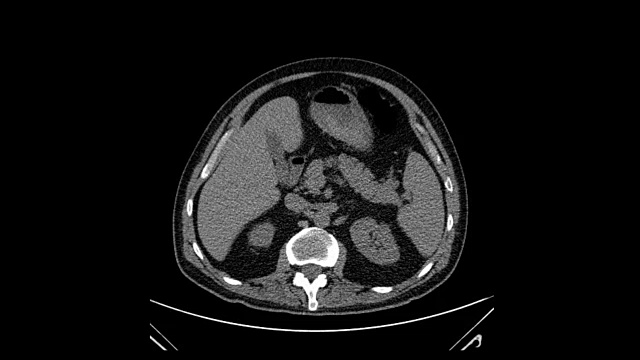 胸腔Cat扫描视频素材
