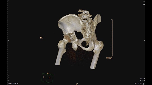 骨盆骨CT扫描。视频素材
