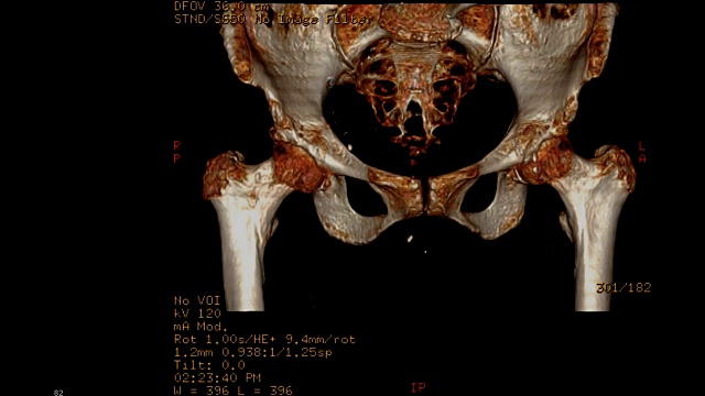 骨盆骨或双髋部CT扫描图像。视频素材